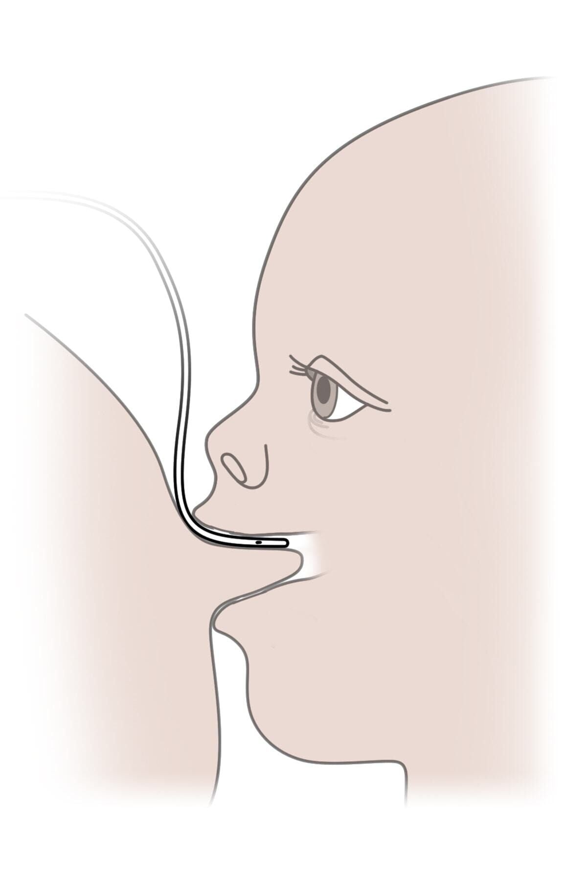 Eday Emzirme Destek Sistemi Eds ml -ayd